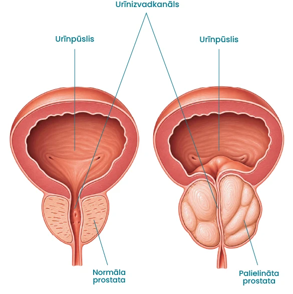 Normāla prostata un palielināta prostata, kas saspiež urīnizvadkanālu
